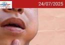 സംസ്ഥാനത്ത് മുണ്ടിനീര് പടരുന്നു; ഈ മാസം കണ്ടെത്തിയത് 475 കേസുകൾ.