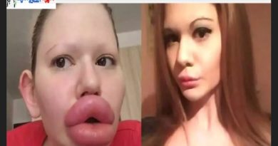 32 കുത്തിവെപ്പുകൾ, ചെലവായത് 26,000 ഡോളർ; ലോകത്തിലെ ഏറ്റവും വലിയ ചുണ്ട് സ്വന്തമാക്കിയ യുവതി